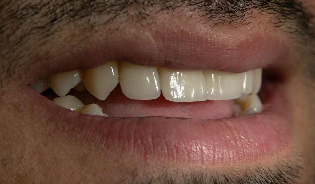Prečo nám počas života nenarastú tretie zuby? Bude to vďaka vede vôbec niekedy možné?
